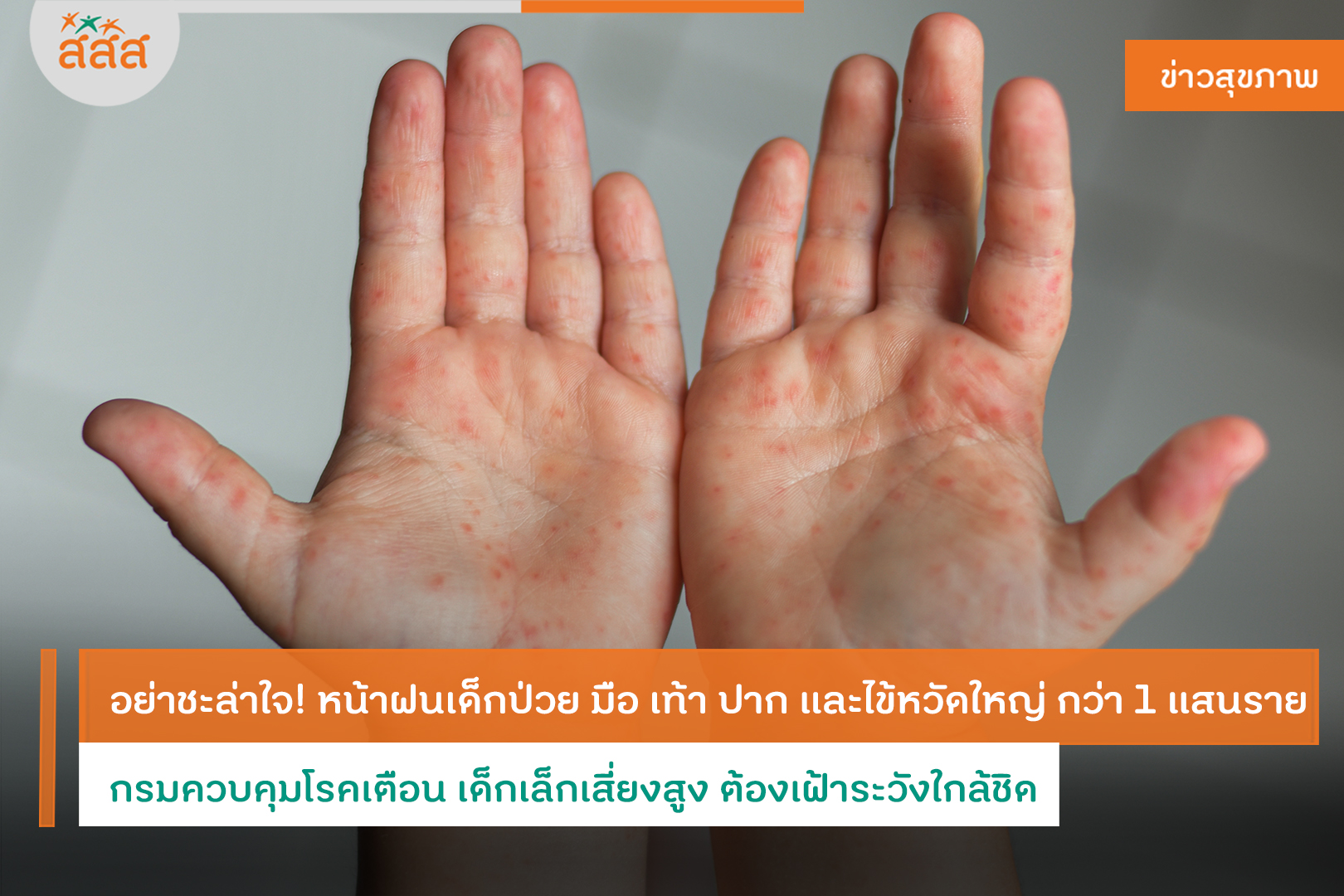 ปกข่าว อย่าชะล่าใจ! หน้าฝนเด็กป่วย มือ เท้า ปาก และไข้หวัดใหญ่ กว่า 1 แสนราย กรมควบคุมโรคเตือน เด็กเล็กเสี่ยงสูง ต้องเฝ้าระวังใกล้ชิด